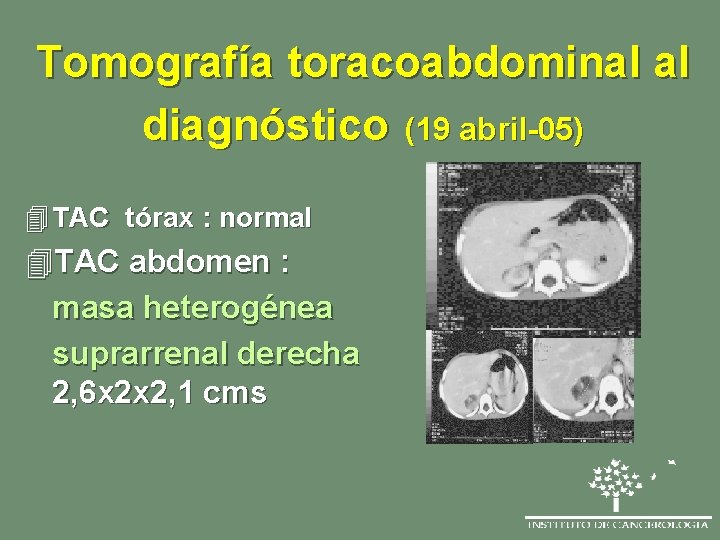 Tomografía toracoabdominal al diagnóstico (19 abril-05) 4 TAC tórax : normal 4 TAC abdomen