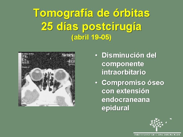 Tomografía de órbitas 25 días postcirugía (abril 19 -05) • Disminución del componente intraorbitario