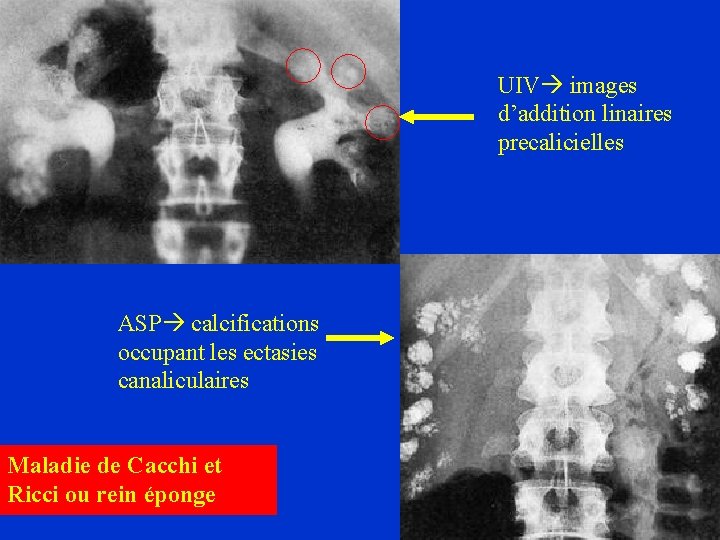 UIV images d’addition linaires precalicielles ASP calcifications occupant les ectasies canaliculaires Maladie de Cacchi