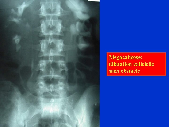 Megacalicose: dilatation calicielle sans obstacle 
