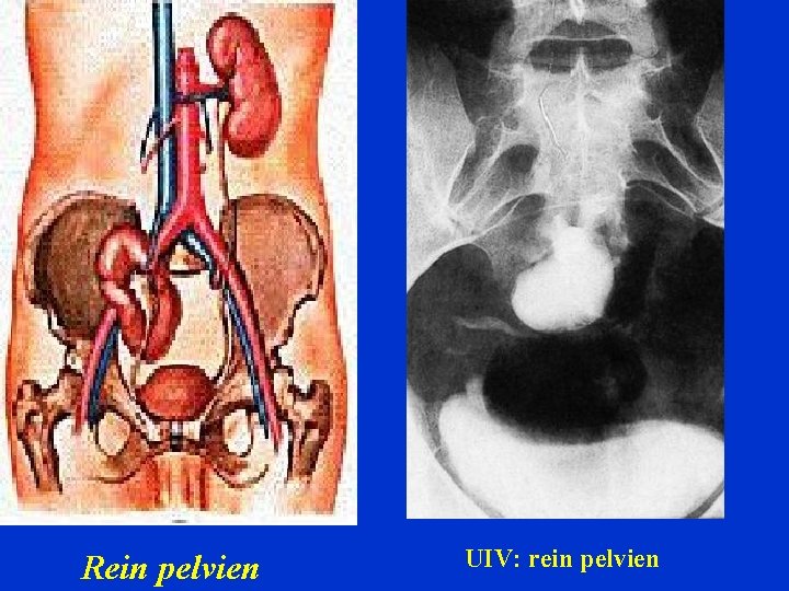 Rein pelvien UIV: rein pelvien 