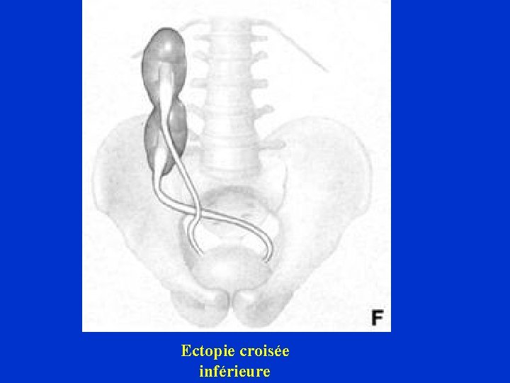 Ectopie croisée inférieure 