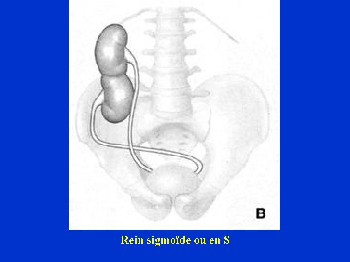 Rein sigmoïde ou en S 