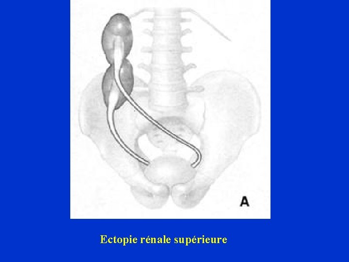 Ectopie rénale supérieure 