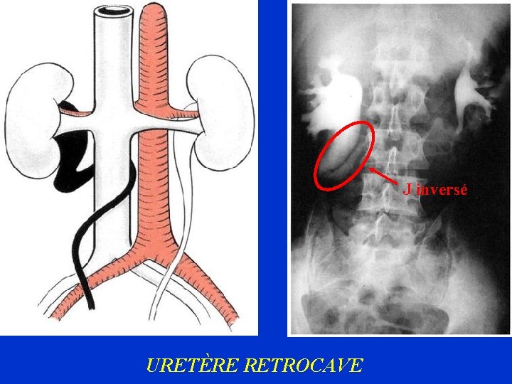J inversé URETÈRE RETROCAVE 