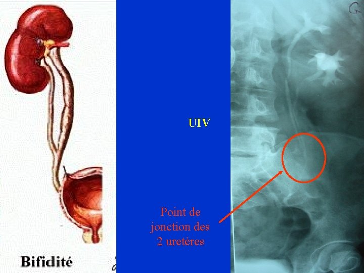 UIV Point de jonction des 2 uretères 