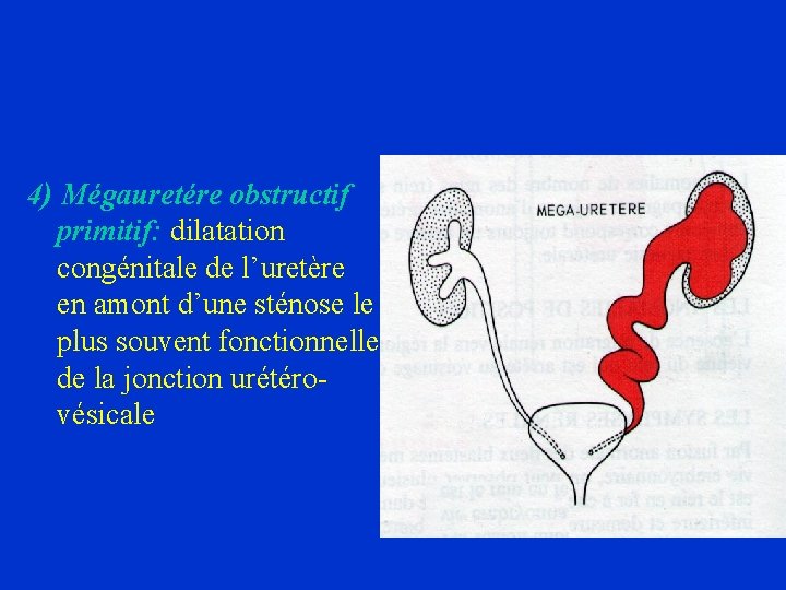 4) Mégauretére obstructif primitif: dilatation congénitale de l’uretère en amont d’une sténose le plus