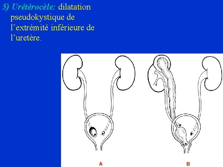 5) Urétérocèle: dilatation pseudokystique de l’extrémité inférieure de l’uretère. 