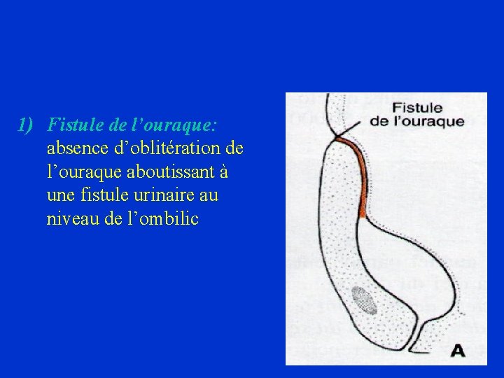 1) Fistule de l’ouraque: absence d’oblitération de l’ouraque aboutissant à une fistule urinaire au