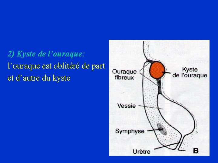 2) Kyste de l’ouraque: l’ouraque est oblitéré de part et d’autre du kyste 