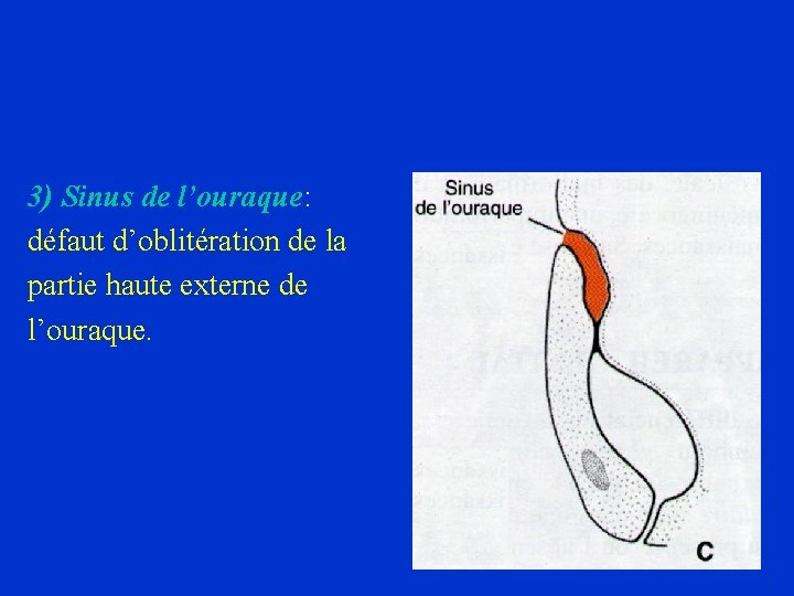 3) Sinus de l’ouraque: défaut d’oblitération de la partie haute externe de l’ouraque. 