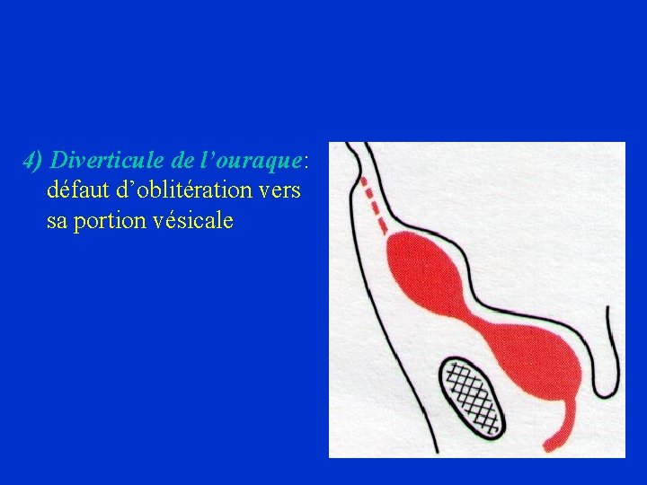4) Diverticule de l’ouraque: défaut d’oblitération vers sa portion vésicale 