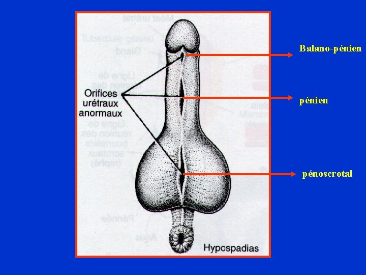 Balano-pénien pénoscrotal 