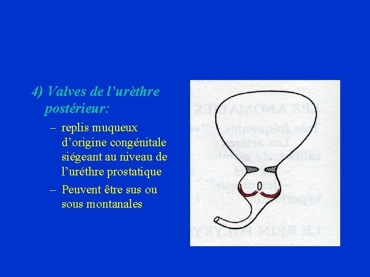 4) Valves de l’urèthre postérieur: – replis muqueux d’origine congénitale siégeant au niveau de