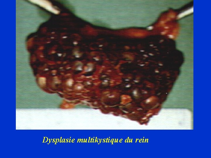 Dysplasie multikystique du rein 