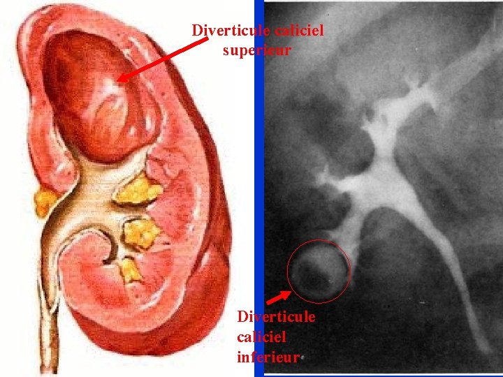 Diverticule caliciel superieur Diverticule caliciel inferieur 