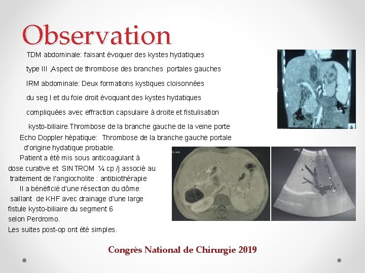 Observation TDM abdominale: faisant évoquer des kystes hydatiques type III , Aspect de thrombose