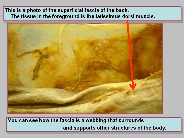 This is a photo of the superficial fascia of the back. The tissue in
