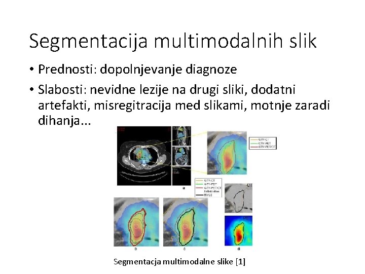 Segmentacija multimodalnih slik • Prednosti: dopolnjevanje diagnoze • Slabosti: nevidne lezije na drugi sliki,
