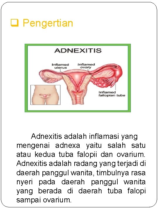 q Pengertian Adnexitis adalah inflamasi yang mengenai adnexa yaitu salah satu atau kedua tuba