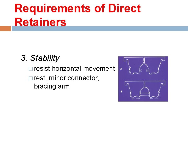 Requirements of Direct Retainers 3. Stability � resist horizontal movement � rest, minor connector,