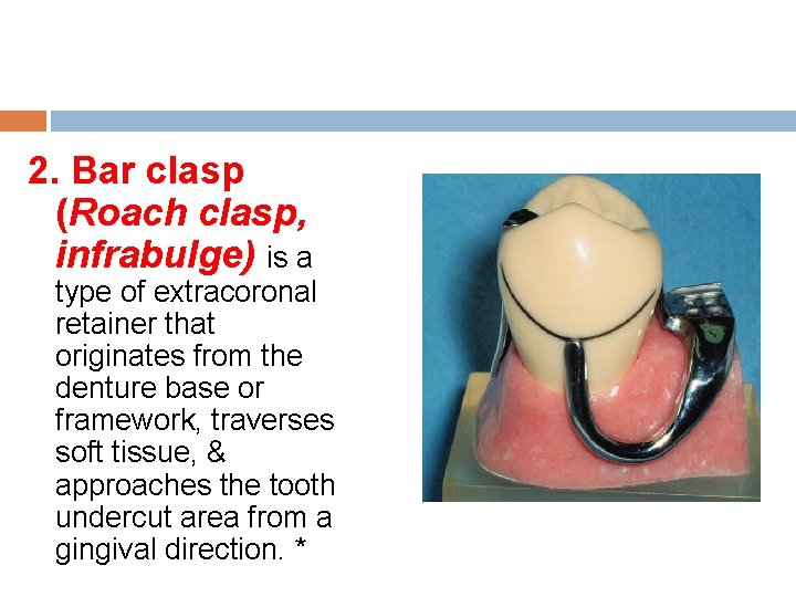 2. Bar clasp (Roach clasp, infrabulge) is a type of extracoronal retainer that originates