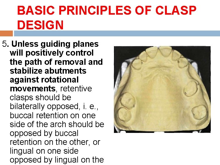 BASIC PRINCIPLES OF CLASP DESIGN 5. Unless guiding planes will positively control the path