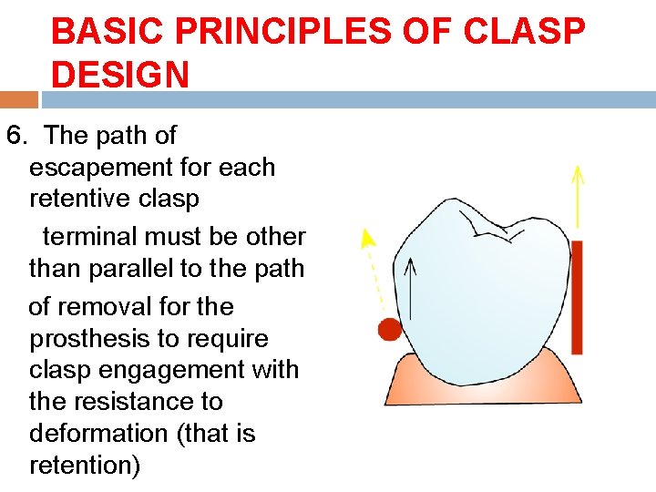 BASIC PRINCIPLES OF CLASP DESIGN 6. The path of escapement for each retentive clasp