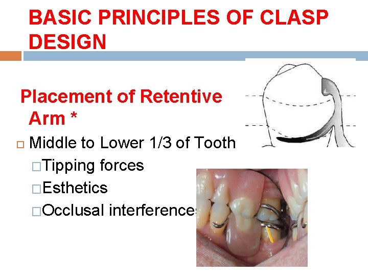 BASIC PRINCIPLES OF CLASP DESIGN Placement of Retentive Arm * Middle to Lower 1/3