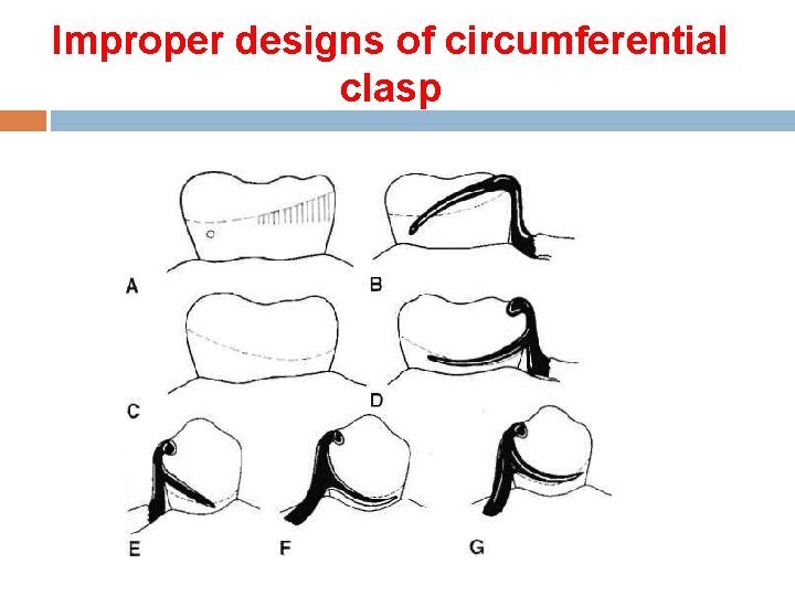 Improper designs of circumferential clasp 