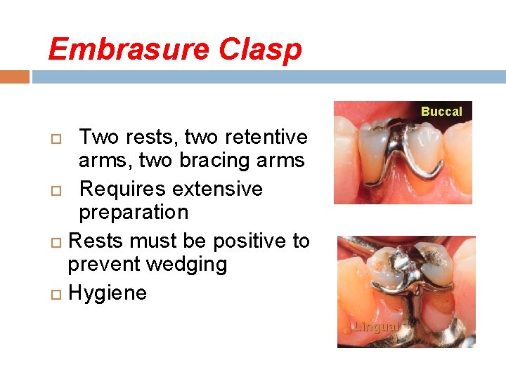 Embrasure Clasp Buccal Two rests, two retentive arms, two bracing arms Requires extensive preparation