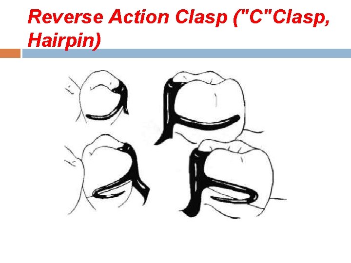 Reverse Action Clasp ("C"Clasp, Hairpin) 