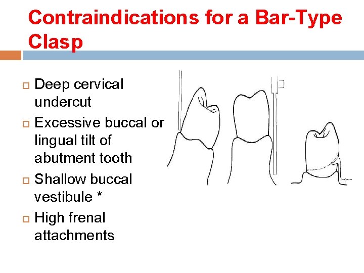 Contraindications for a Bar-Type Clasp Deep cervical undercut Excessive buccal or lingual tilt of