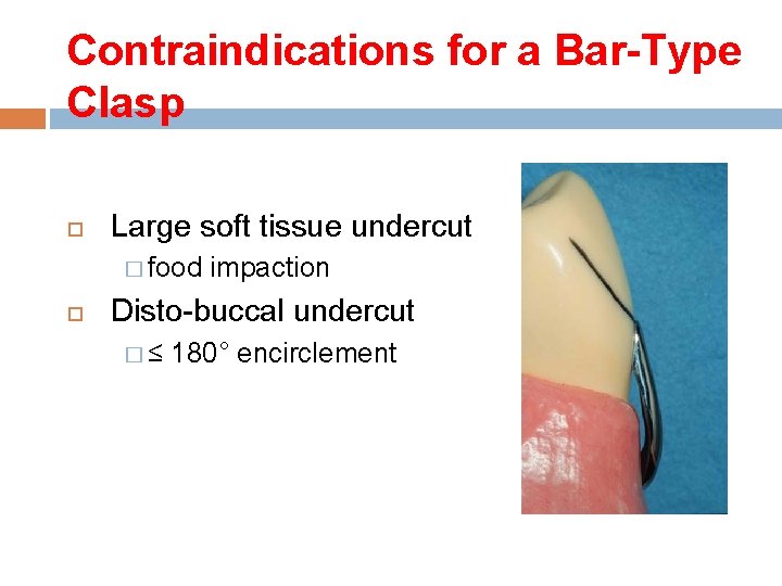 Contraindications for a Bar-Type Clasp Large soft tissue undercut � food impaction Disto-buccal undercut