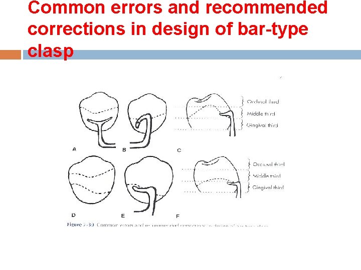 Common errors and recommended corrections in design of bar-type clasp 