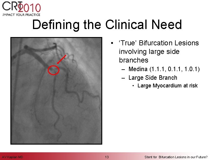 Defining the Clinical Need • ‘True’ Bifurcation Lesions involving large side branches – Medina