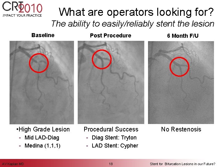 What are operators looking for? The ability to easily/reliably stent the lesion Baseline Post