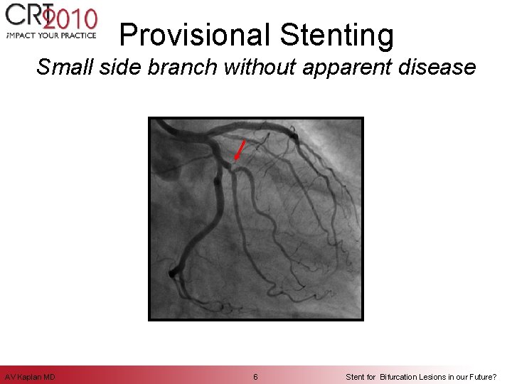 Provisional Stenting Small side branch without apparent disease AV Kaplan MD 6 Stent for