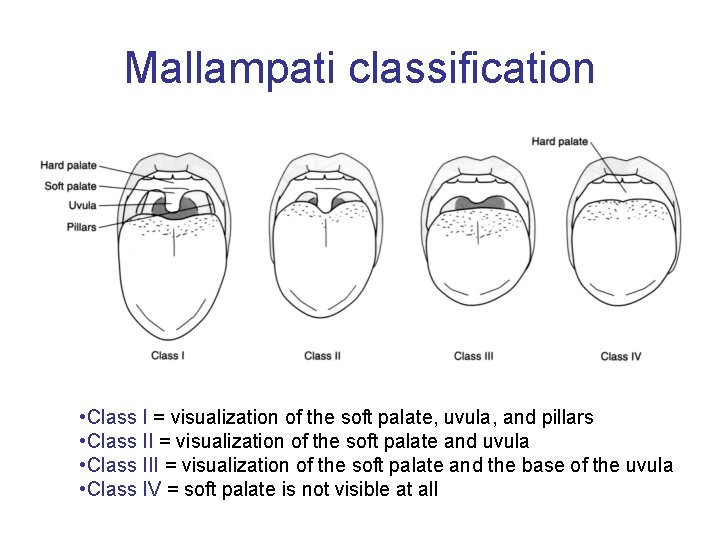 Mallampati classification • Class I = visualization of the soft palate, uvula, and pillars