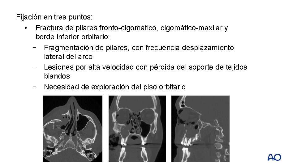 Fijación en tres puntos: • Fractura de pilares fronto-cigomático, cigomático-maxilar y borde inferior orbitario: