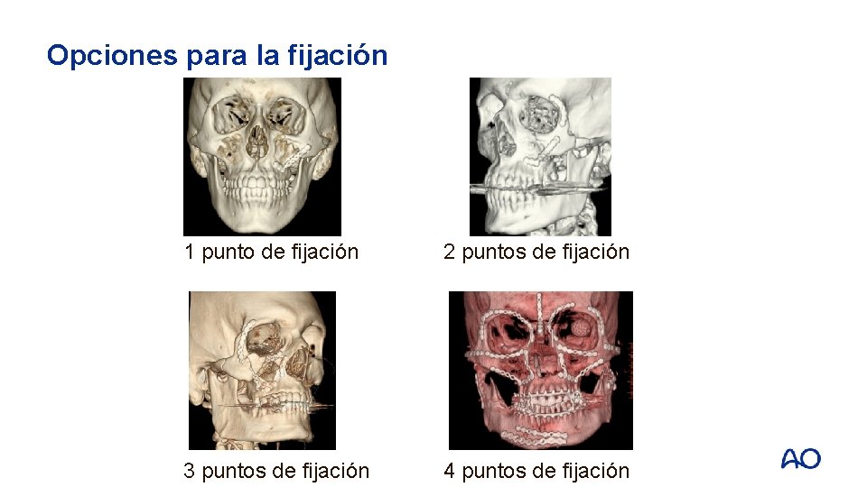 Opciones para la fijación 1 punto de fijación 2 puntos de fijación 3 puntos