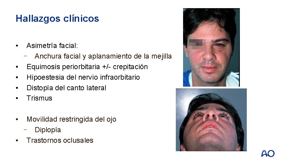 Hallazgos clínicos • • • Asimetría facial: ⎻ Anchura facial y aplanamiento de la