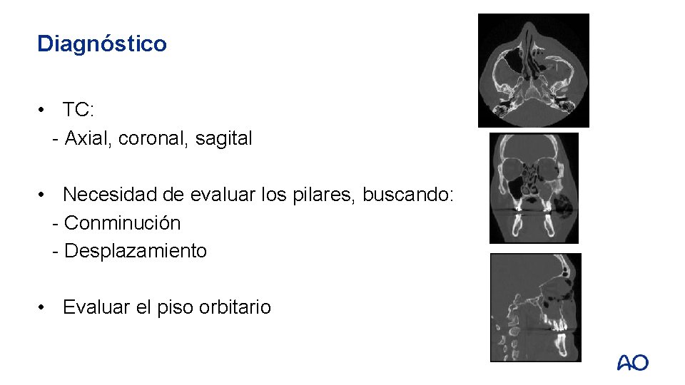 Diagnóstico • TC: - Axial, coronal, sagital • Necesidad de evaluar los pilares, buscando: