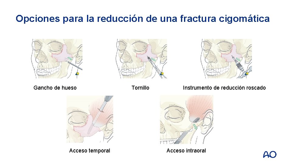 Opciones para la reducción de una fractura cigomática Gancho de hueso Acceso temporal Tornillo