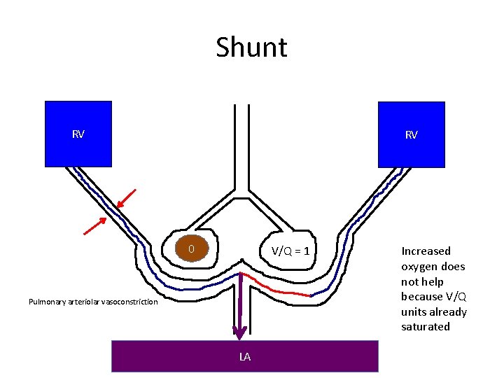 Shunt RV RV 0 V/Q = 1 Pulmonary arteriolar vasoconstriction LA Increased oxygen does