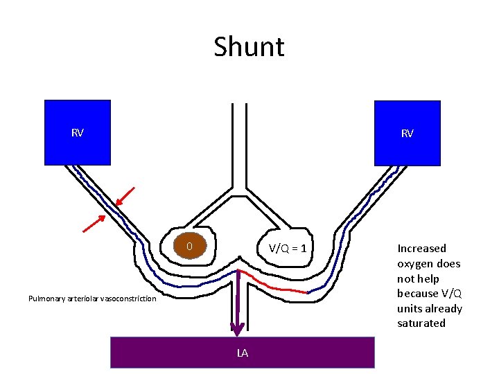 Shunt RV RV 0 V/Q = 1 Pulmonary arteriolar vasoconstriction LA Increased oxygen does Shunt RV RV 0 V/Q = 1 Pulmonary arteriolar vasoconstriction LA Increased oxygen does