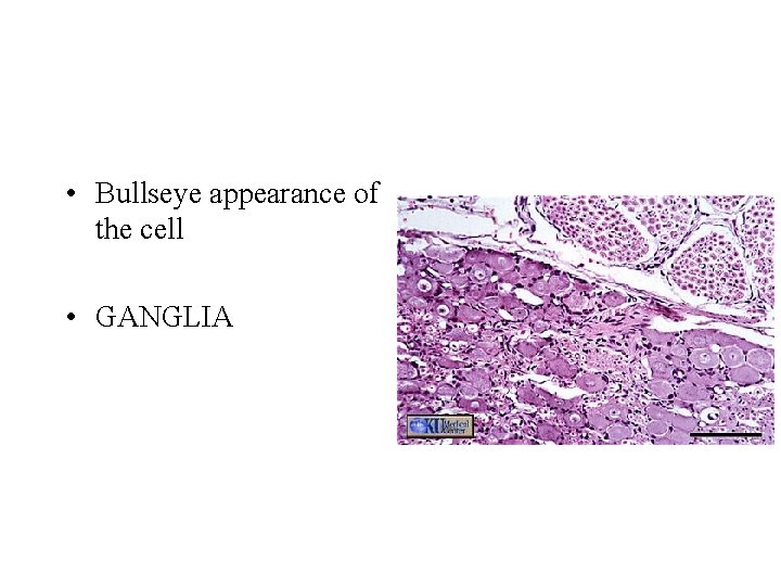  • Bullseye appearance of the cell • GANGLIA 