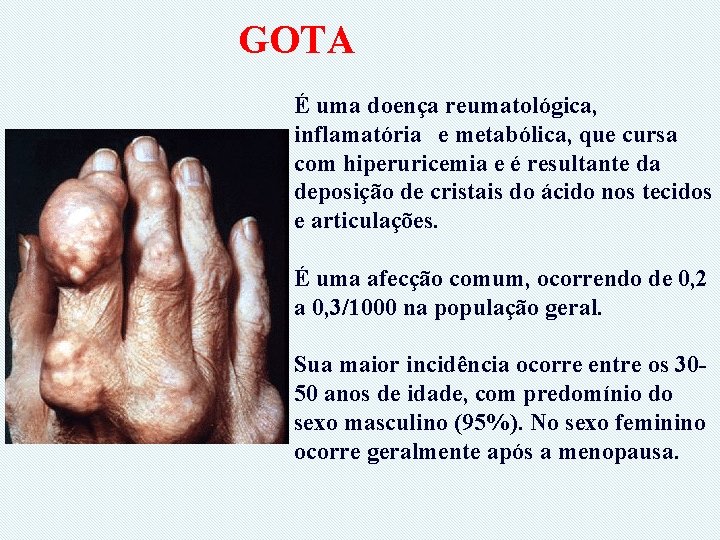 GOTA É uma doença reumatológica, inflamatória e metabólica, que cursa com hiperuricemia e é