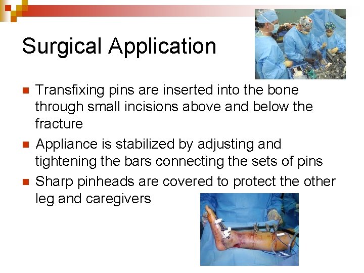 Surgical Application n Transfixing pins are inserted into the bone through small incisions above