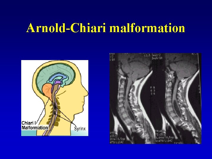 Arnold-Chiari malformation 